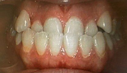 Human teeth that has anterior crossbite problem