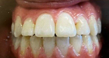 After photo of human teeth that has anterior crossbite problem