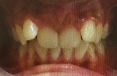 Human teeth that has crowding problem Version 2