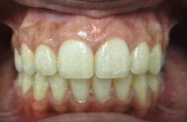 After photo of human teeth that has crowding problem Version 2
