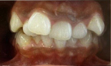 Human teeth that has crowding problem Version 3