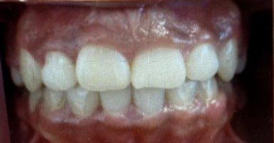 After photo of human teeth that has crowding problem Version 3