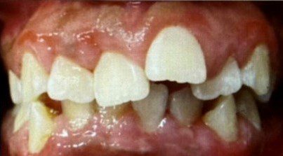Human teeth that has crowding problem Version 1