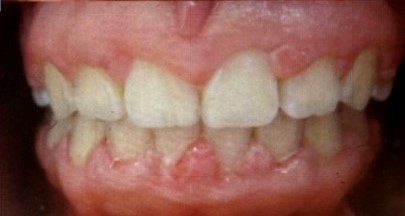 After photo of human teeth that has crowding problem Version 1