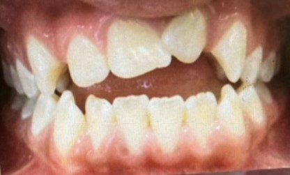 Human teeth with impaction
