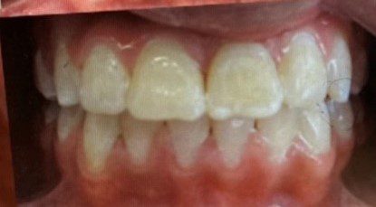 After photo of human teeth that has impaction