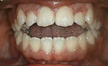 Human teeth with open bite problem