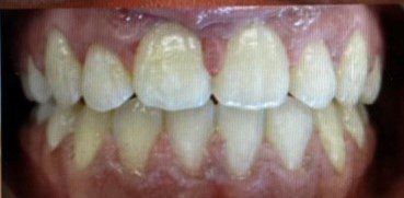 After photo of human teeth that has open bite problem