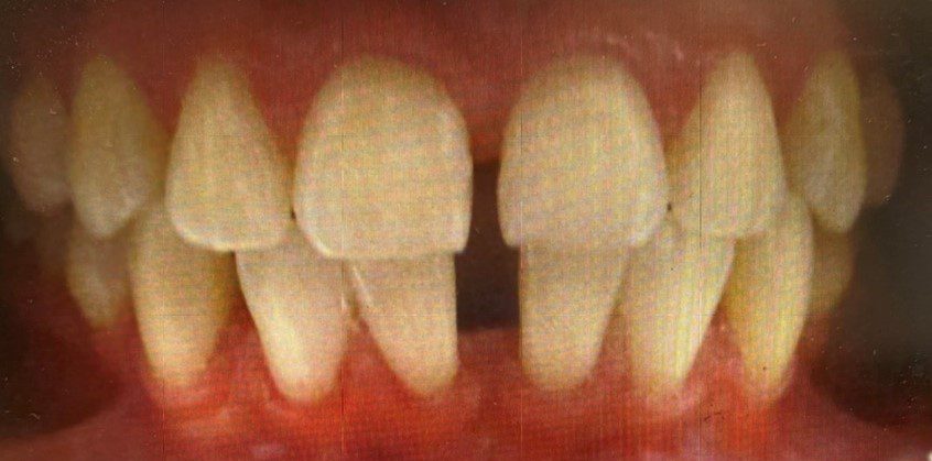 Human teeth with space problem