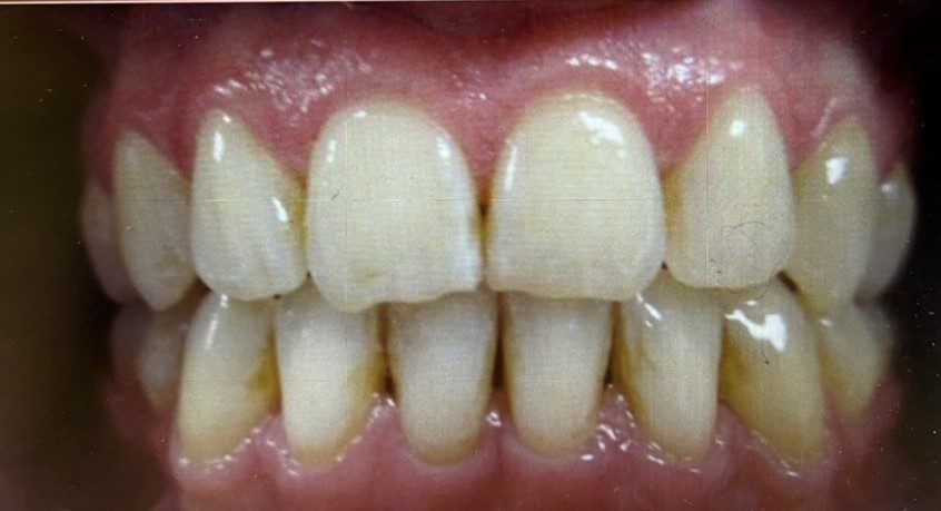 After photo of human teeth that has space problem